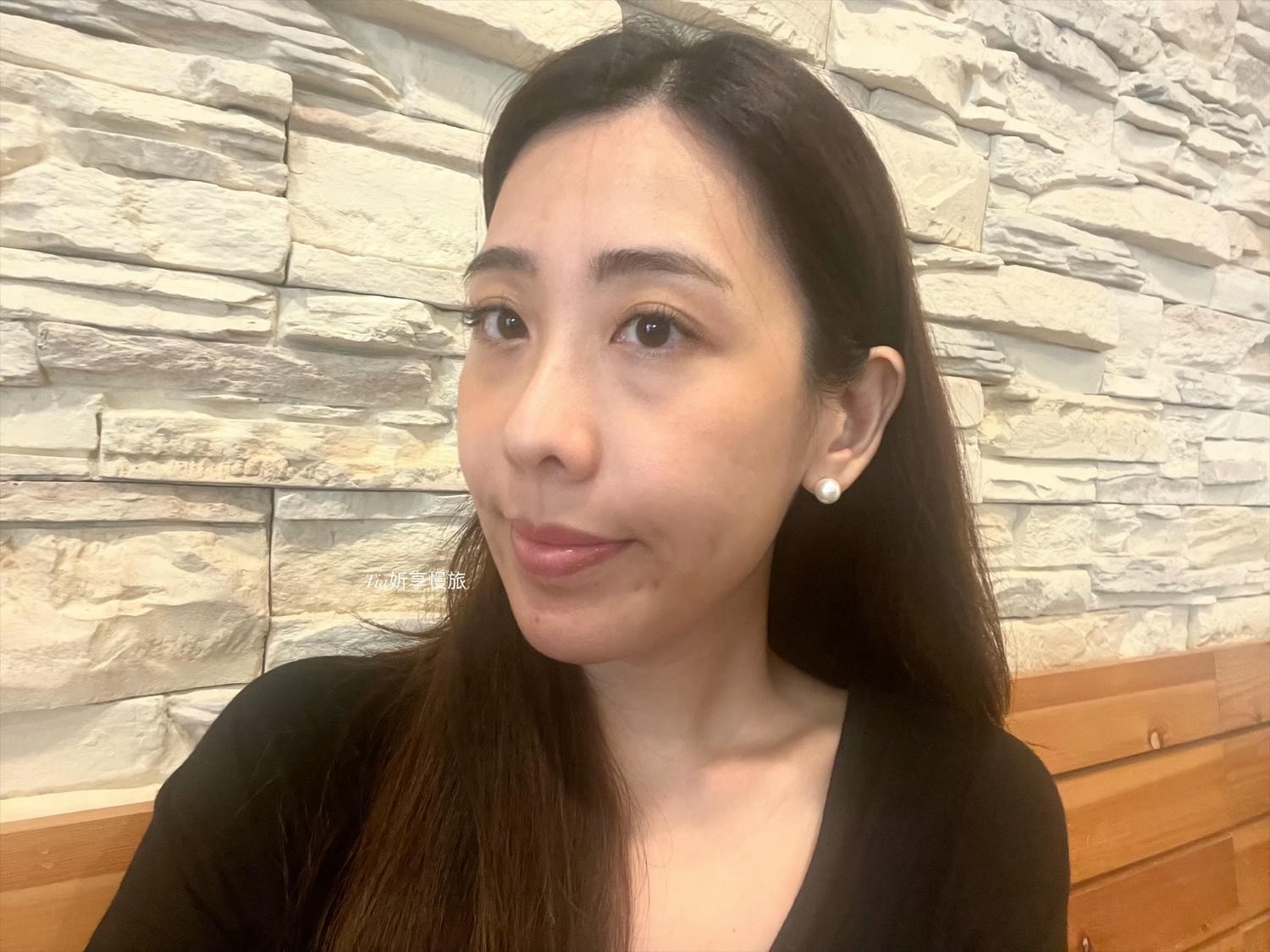 台北彥靚診所|法令紋、淚溝、下巴、太陽穴玻尿酸評價分享 - 第6張圖 台北彥靚診所|法令紋、淚溝、下巴、太陽穴玻尿酸評價分享