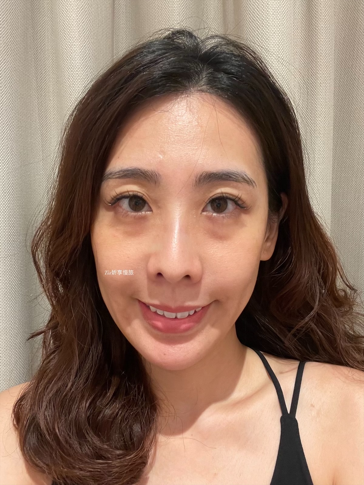 台北彥靚診所|法令紋、淚溝、下巴、太陽穴玻尿酸評價分享 - 第8張圖 台北彥靚診所|法令紋、淚溝、下巴、太陽穴玻尿酸評價分享